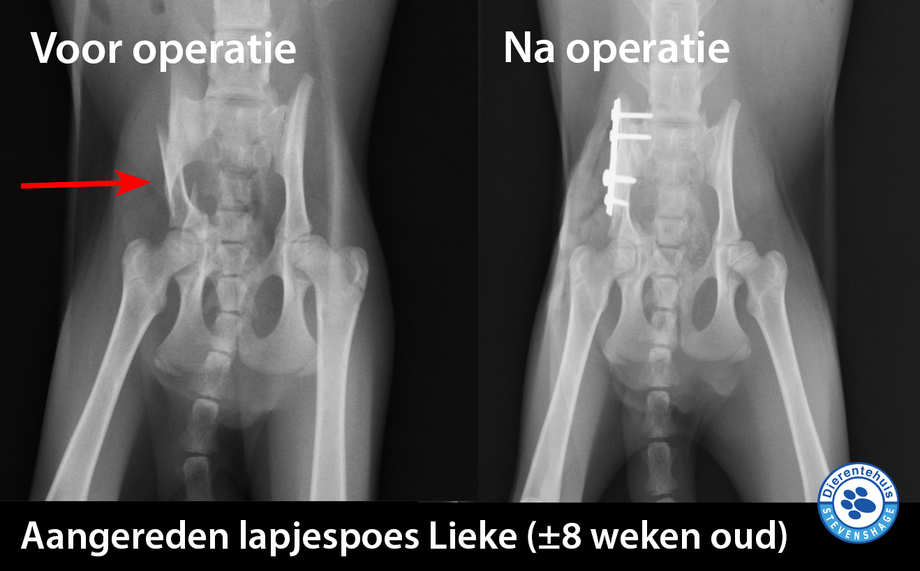 De operatie van Lieke's bekken verloopt voorspoedig.